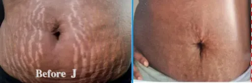 Side-by-side before-and-after close-up of a belly with stretch marks and smoother skin.
