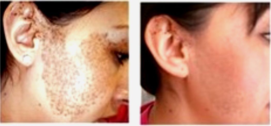 Side-by-side profile photos showing facial skin discoloration and a clear complexion improvement
