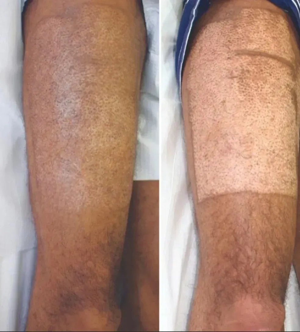 Two photos of a lower leg showing a skin rash and a lighter rectangular patch after treatment