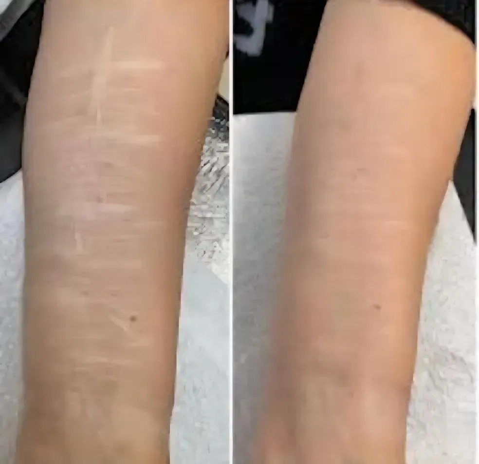 Side-by-side close-up of a forearm before and after treatment, showing reduced skin discoloration.