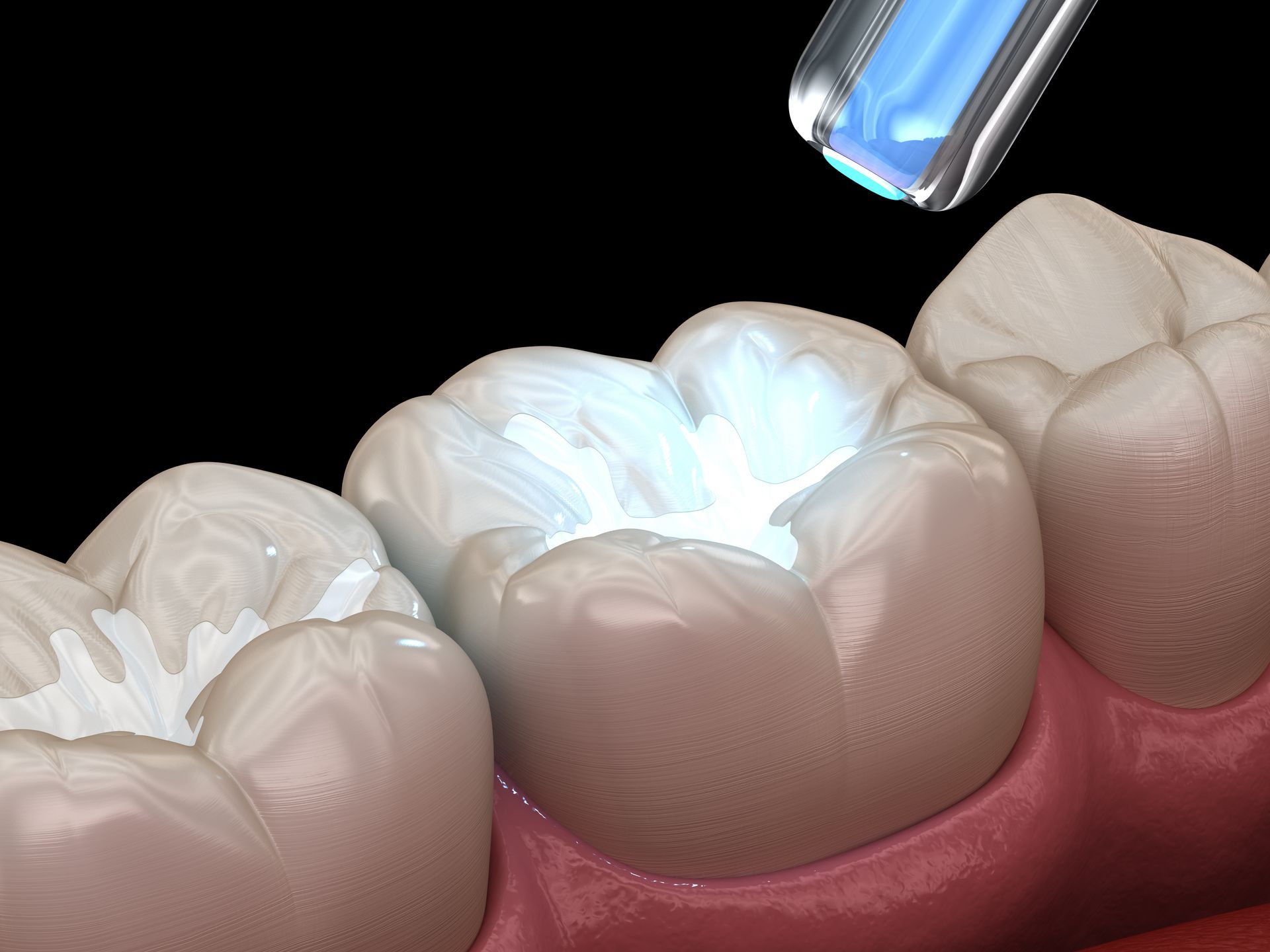 teeth fillings in West Haven, UT