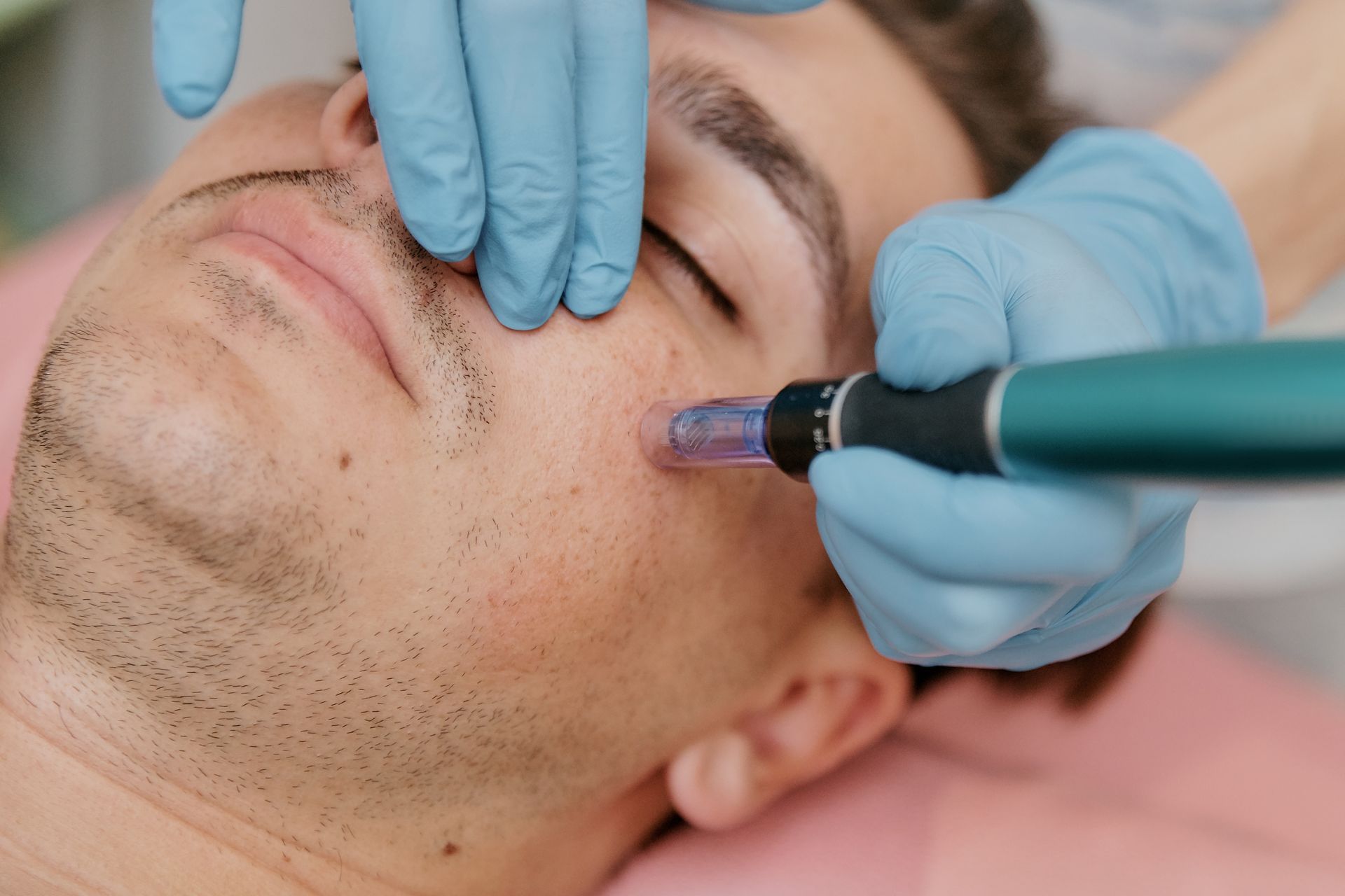 Gloved practitioner using a dermaroller on a man’s cheek during a facial treatment