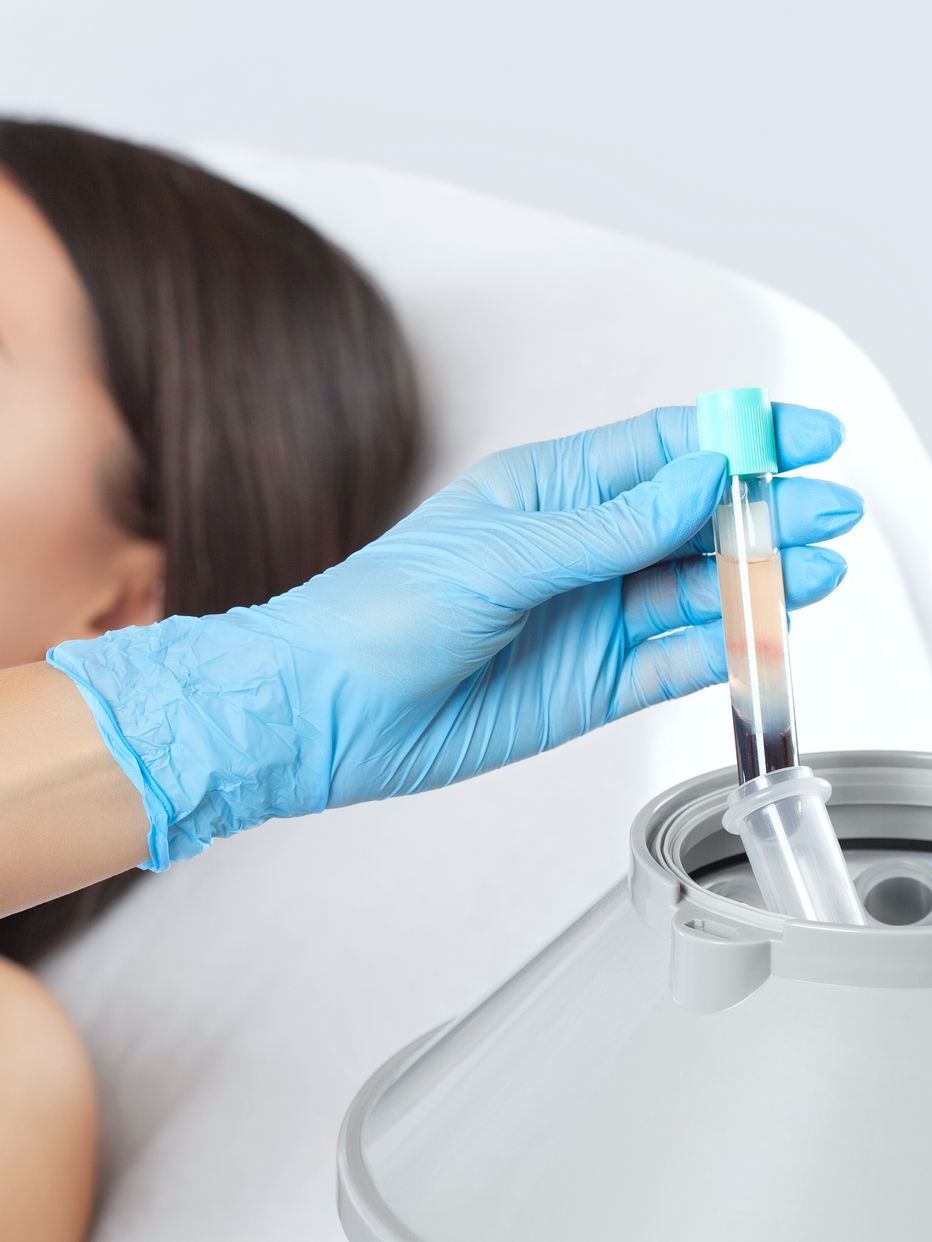 A PRP therapy in process