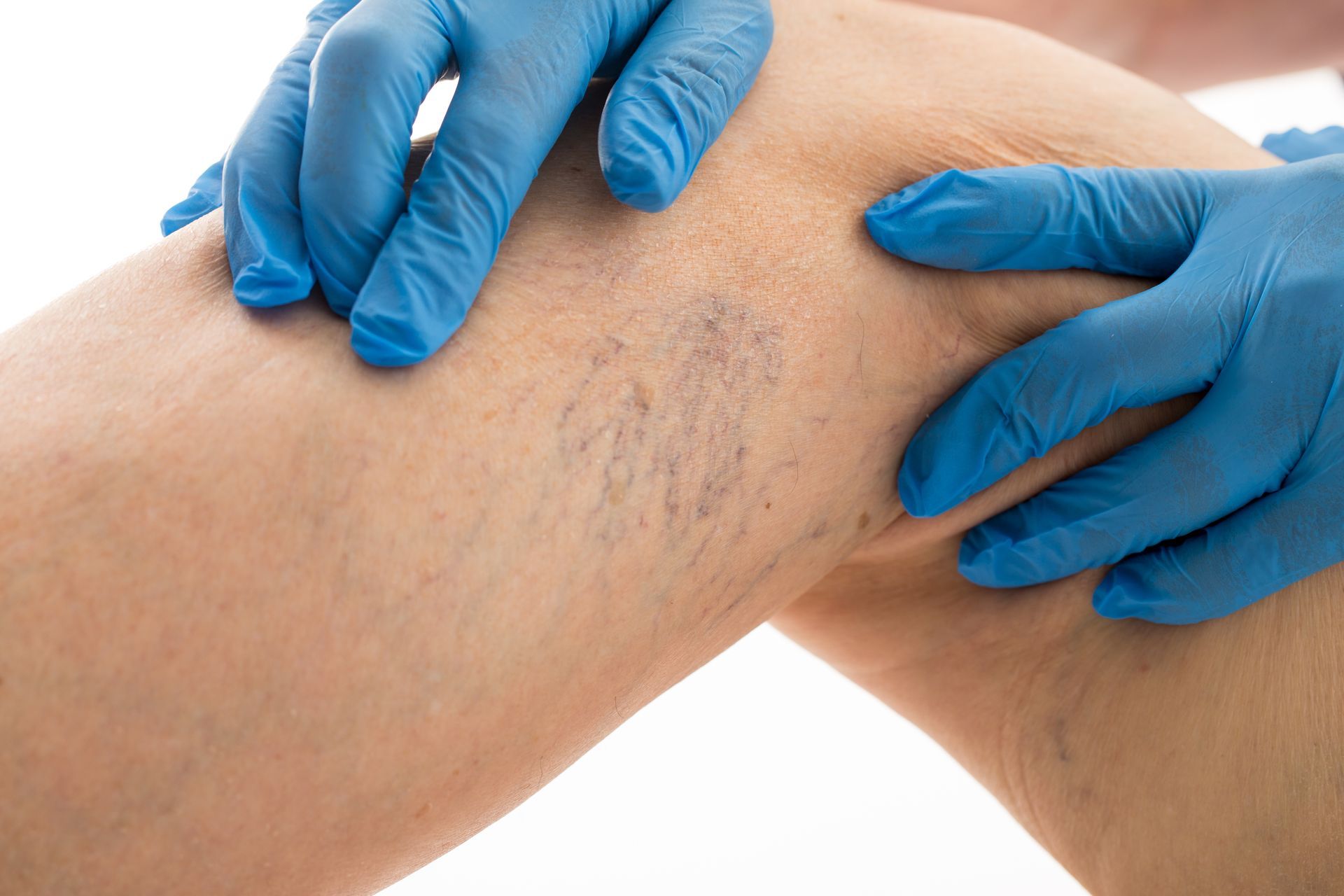 A person wearing blue gloves is examining a woman 's leg with varicose veins.