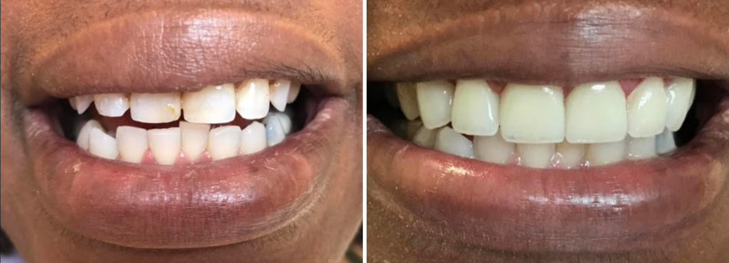 Before and after