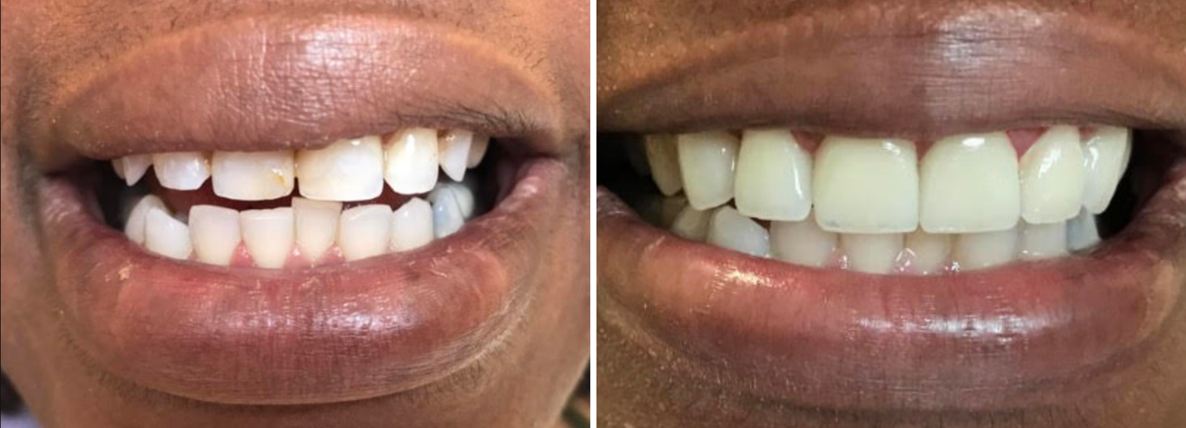A before and after picture of a woman 's teeth.