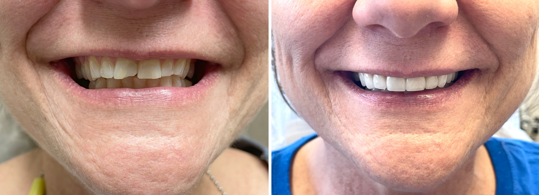 A before and after photo of a woman 's teeth.