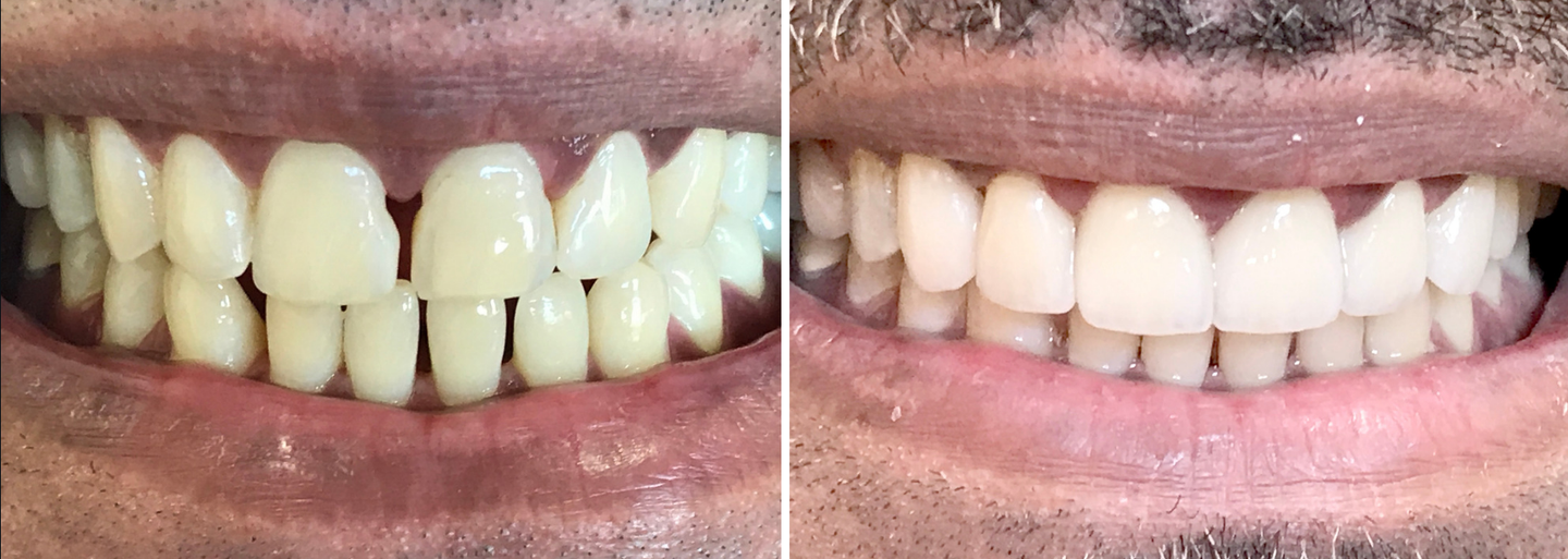 before and after