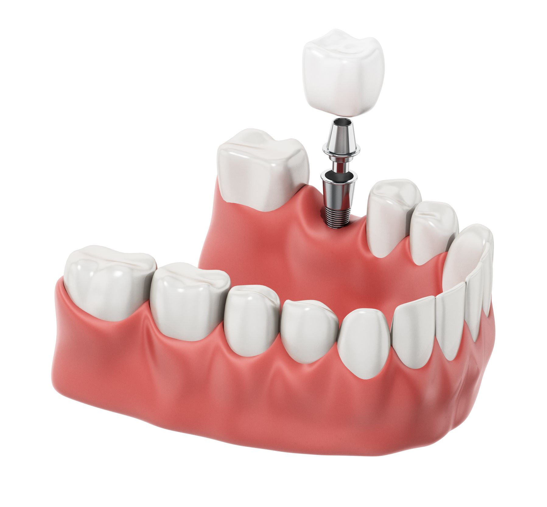 A model of a dental implant in a lower jaw.
