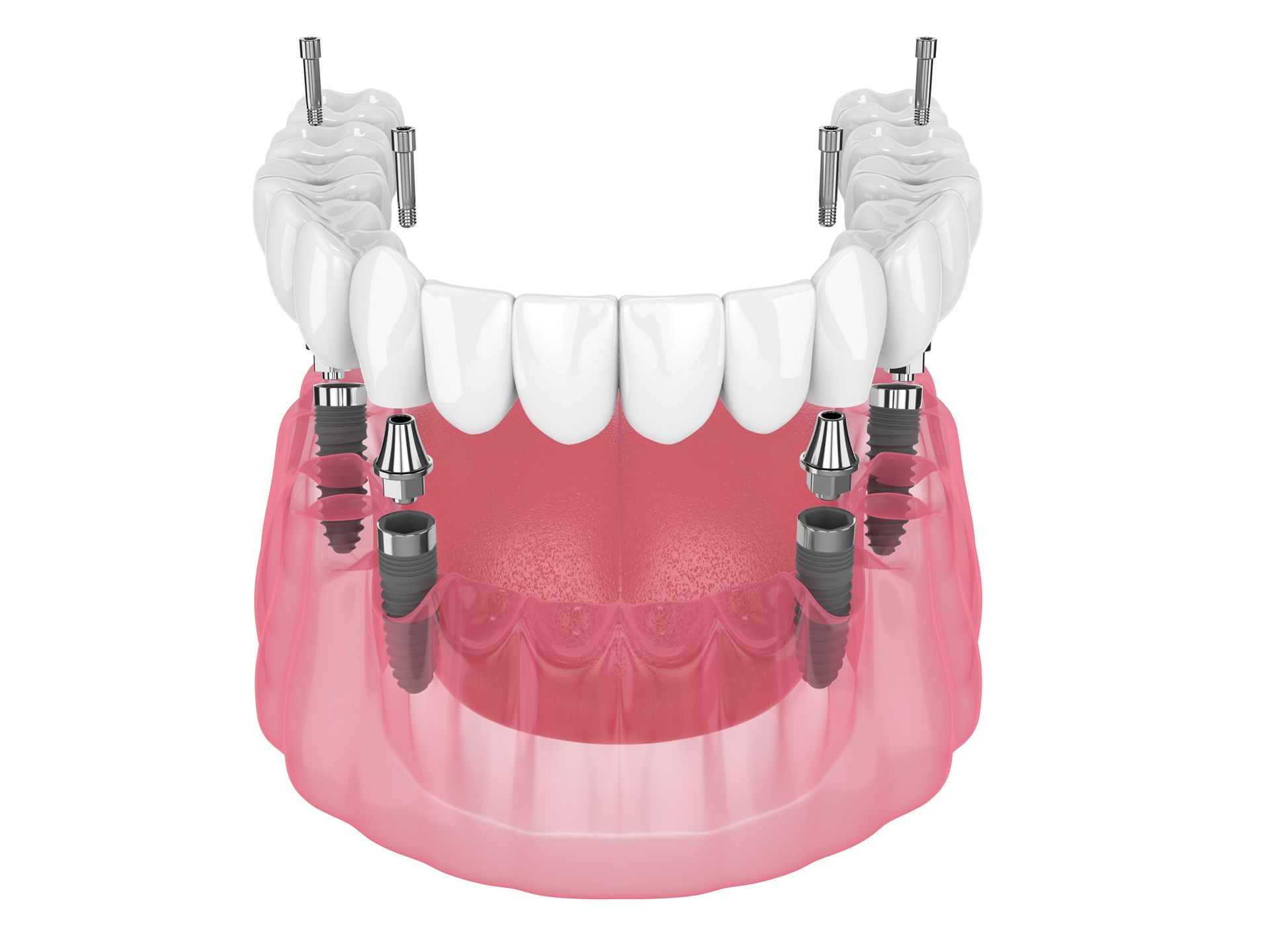 An illustration of a full denture with dental implants.