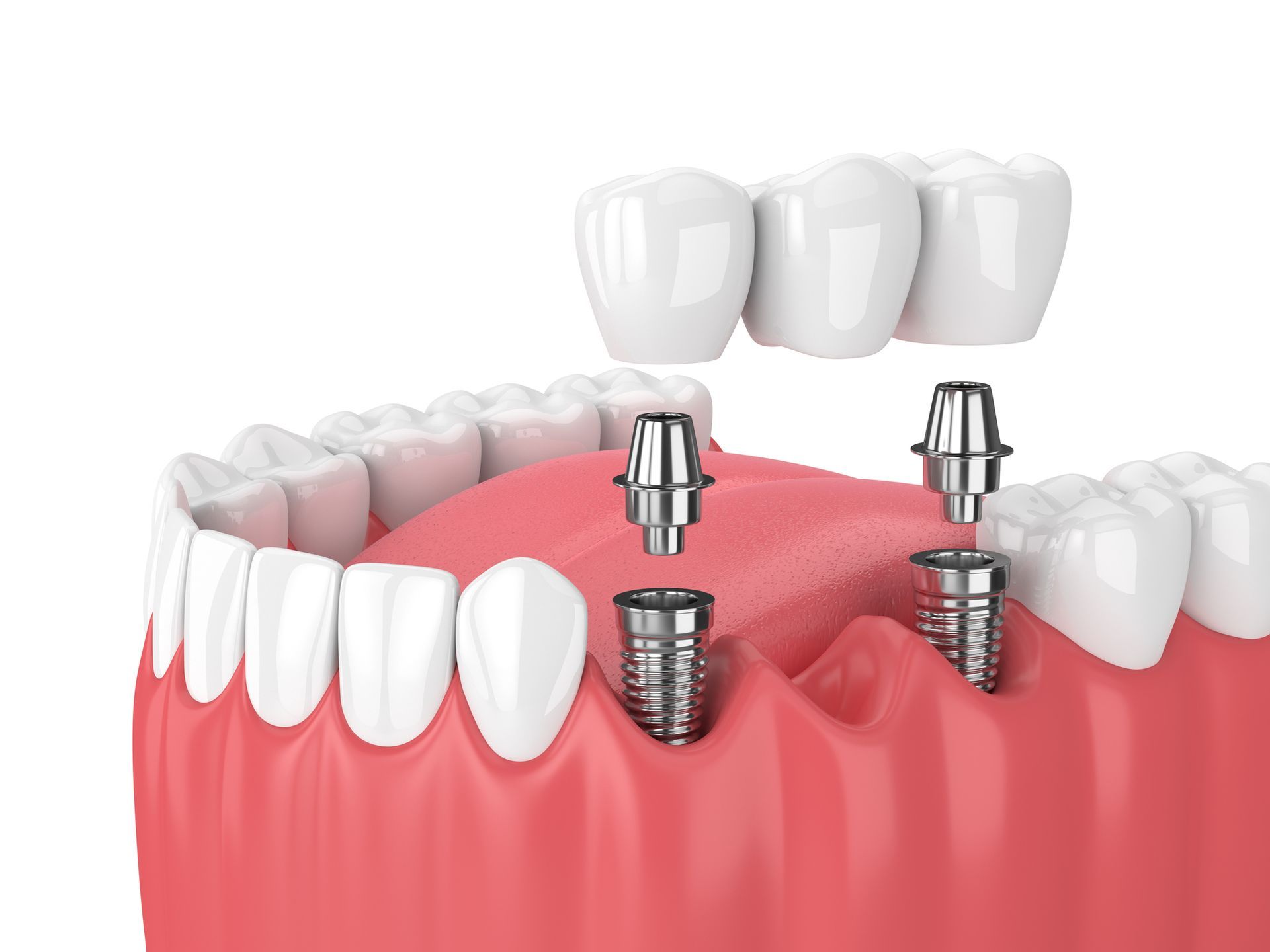 A 3d rendering of a dental bridge with dental implants.