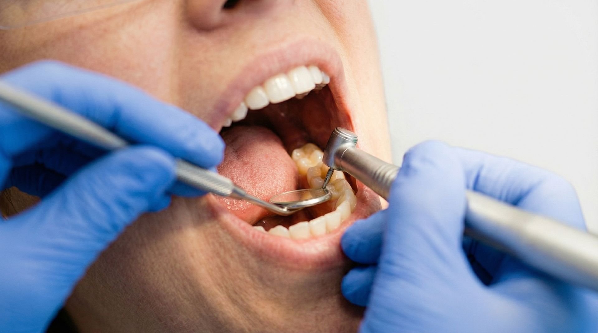 A dentist in blue gloves uses a mouth mirror and a dental drill to treat a patient's lower molars.