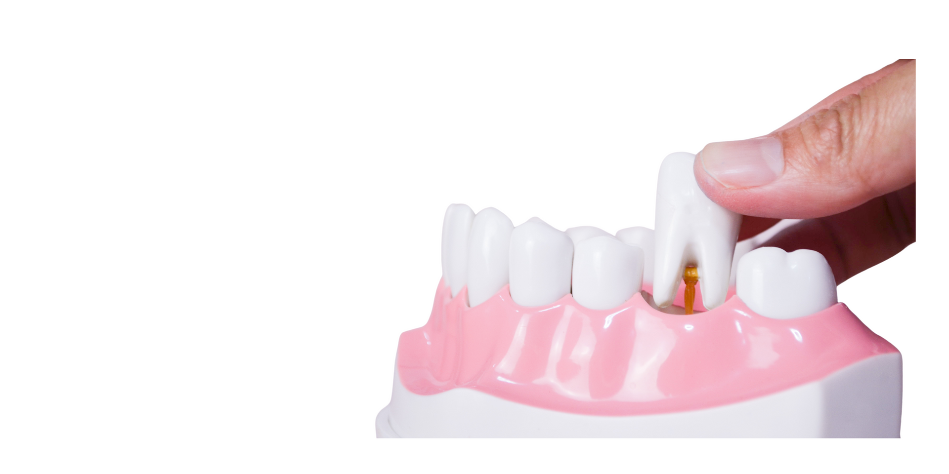 a person is holding a model of a tooth with a hole in it .