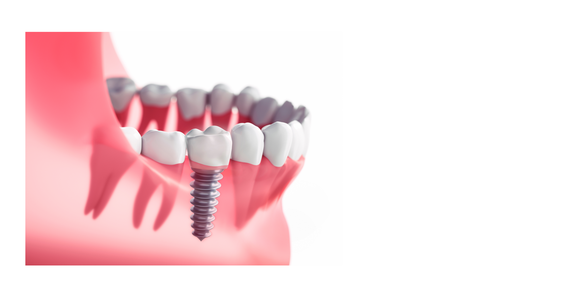 a model of a tooth with a dental implant in it .