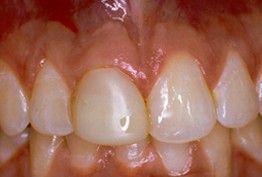 a close up of a person 's teeth and gums .