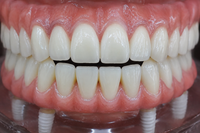 Dental implant model with a missing tooth and removable crown on a pink gum base