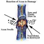 Reaction of Axon to Damage — Omaha, NE — Law Office of Stephen L. Gerdes Reaction of Axon to Damage — Omaha, NE — Law Office of Stephen L. Gerdes