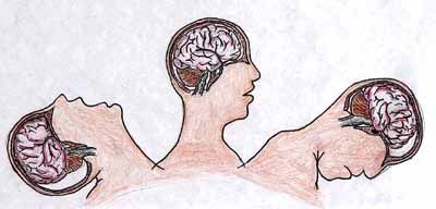 Diffuse Axonal Injury — Omaha, NE — Law Office of Stephen L. Gerdes Diffuse Axonal Injury — Omaha, NE — Law Office of Stephen L. Gerdes