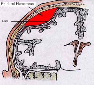 Epidural Hematoma — Omaha, NE — Law Office of Stephen L. Gerdes Epidural Hematoma — Omaha, NE — Law Office of Stephen L. Gerdes