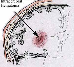 Intracerebral Hematomas — Omaha, NE — Law Office of Stephen L. Gerdes Intracerebral Hematomas — Omaha, NE — Law Office of Stephen L. Gerdes