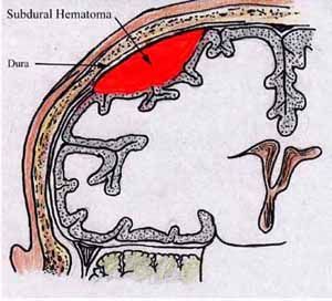 Subdural Hematoma — Omaha, NE — Law Office of Stephen L. Gerdes Subdural Hematoma — Omaha, NE — Law Office of Stephen L. Gerdes