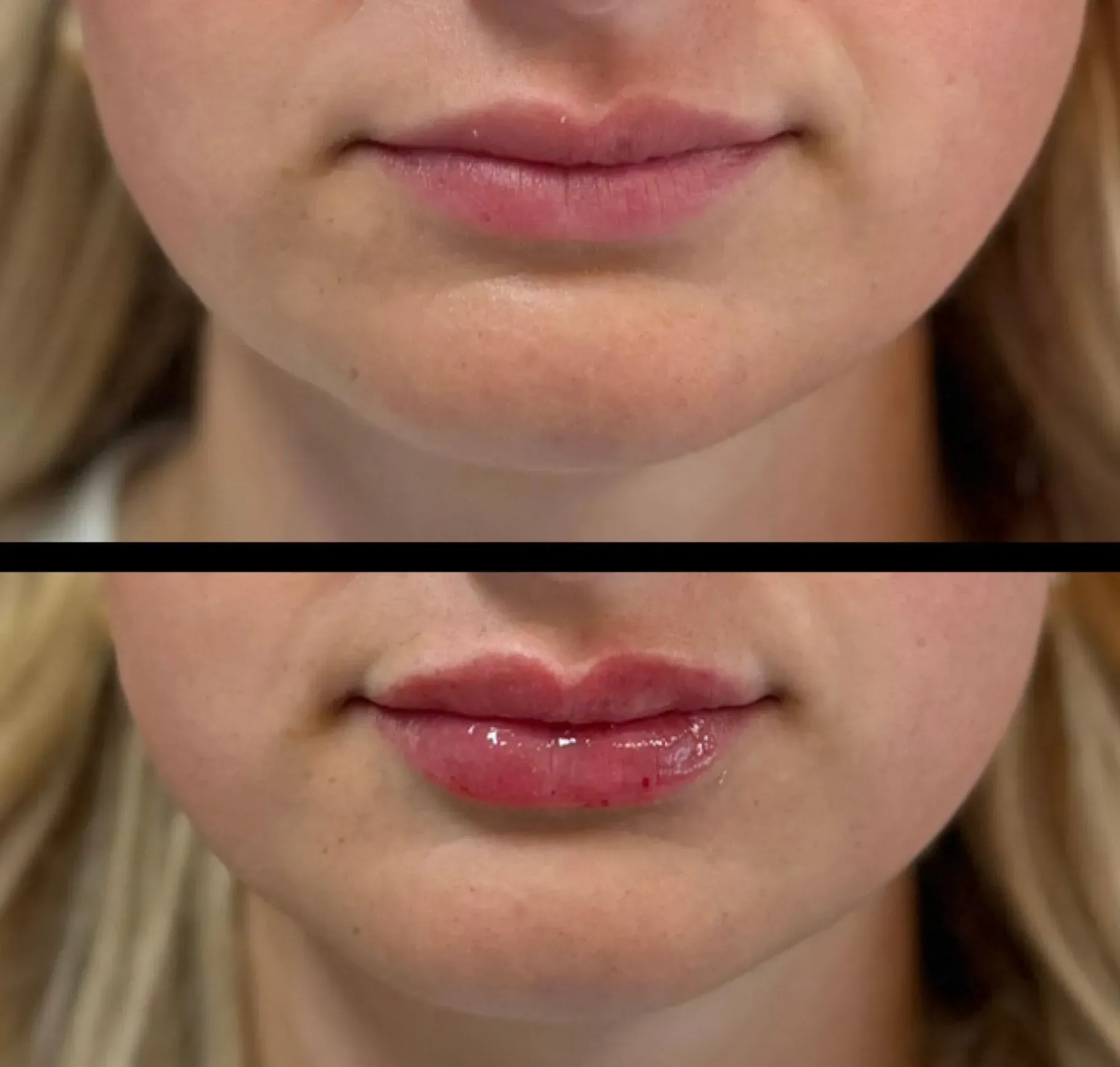 Comparison of lips before and after lip filler treatment.
