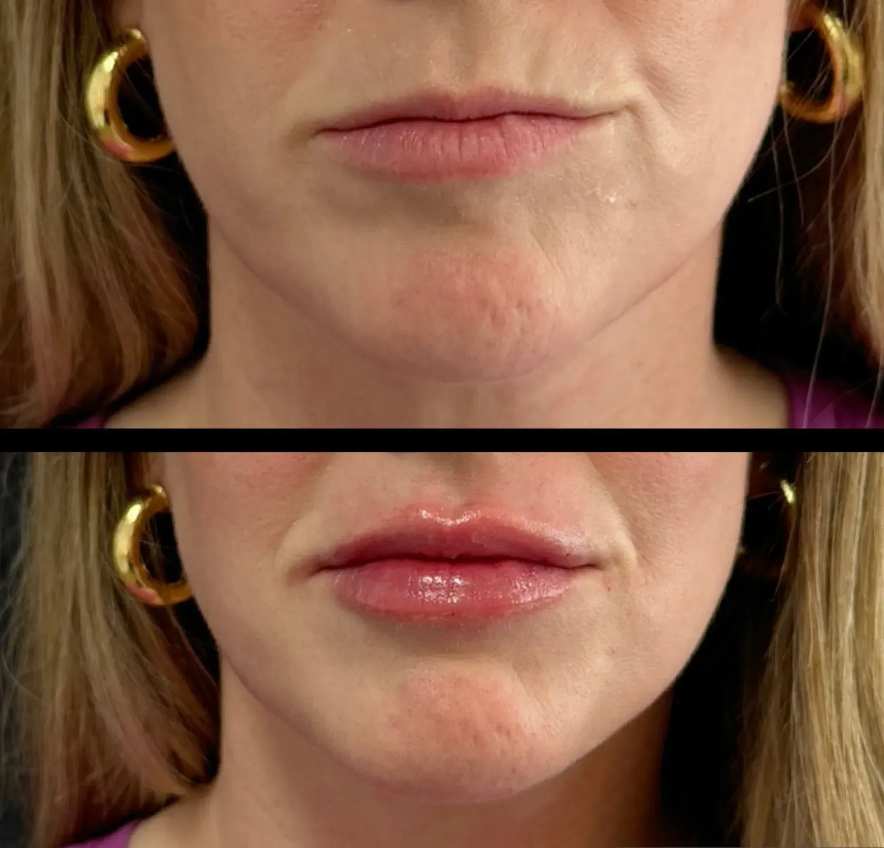 Comparison of woman's lips before and after lip augmentation, bottom image showing fuller, glossier lips.