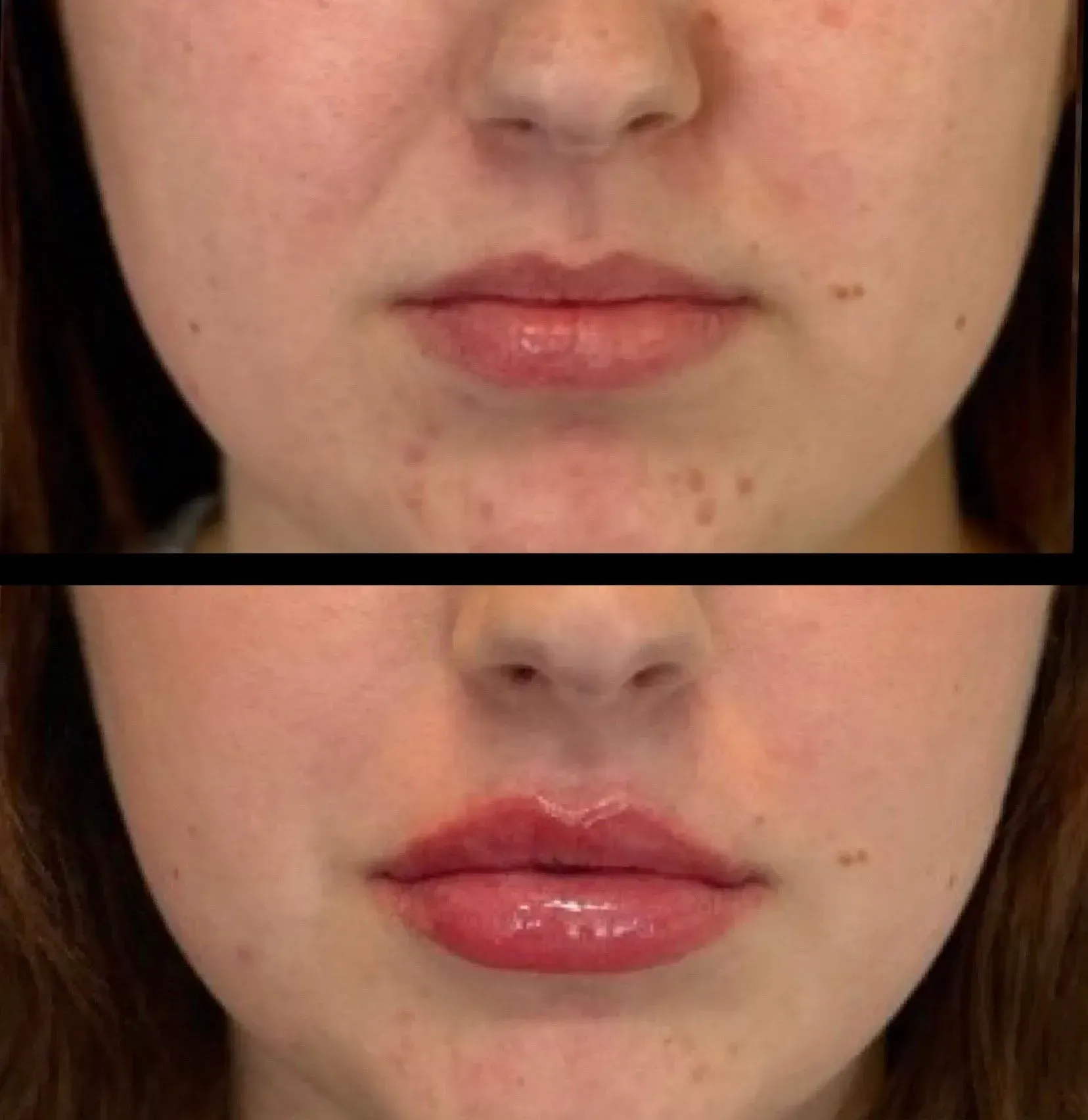 Two photos: before and after lip filler treatment, showing fuller, plumper lips.
