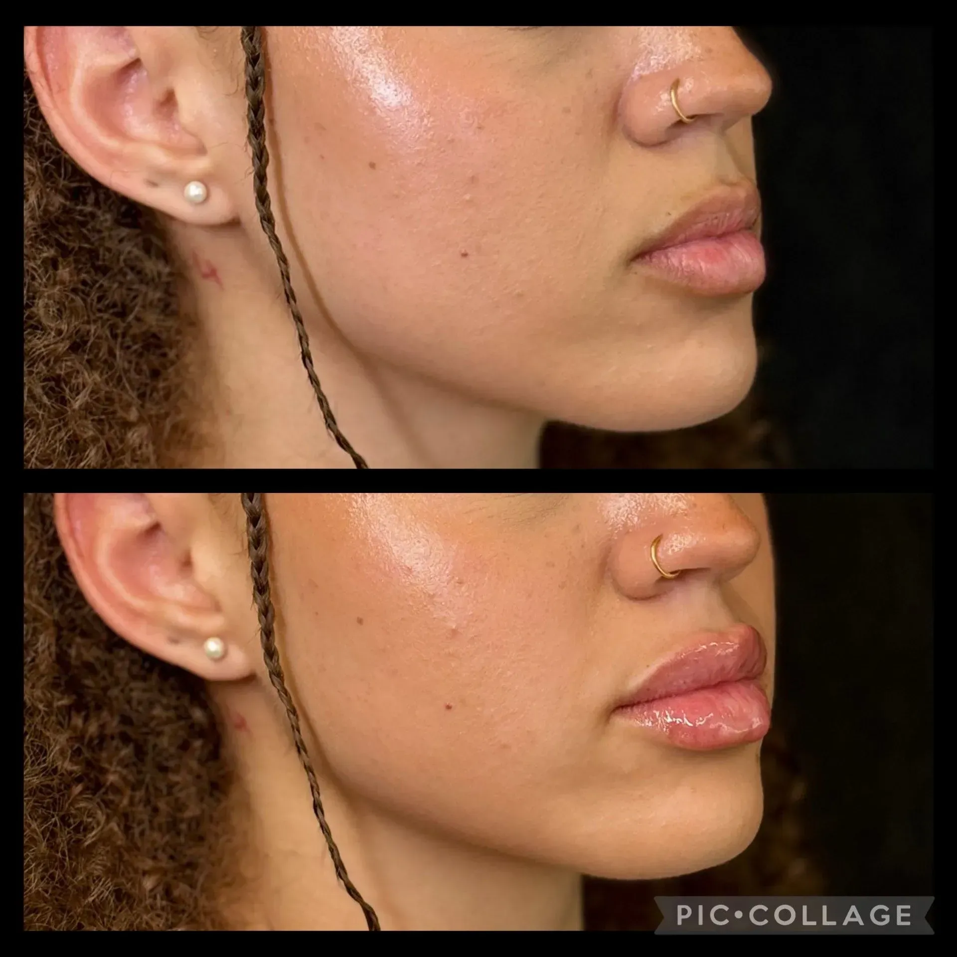Side-by-side comparison of a person's profile. Top: natural lips. Bottom: lips appear fuller, likely enhanced.