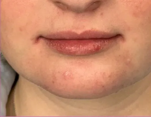 Close-up of a person's lips and chin with visible blemishes and red skin.