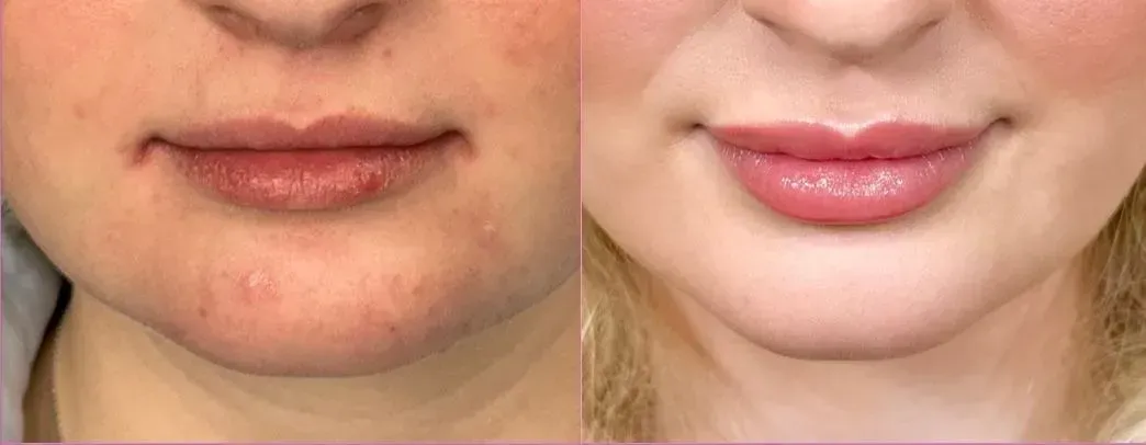 Before-and-after of a person's lower face. The 
