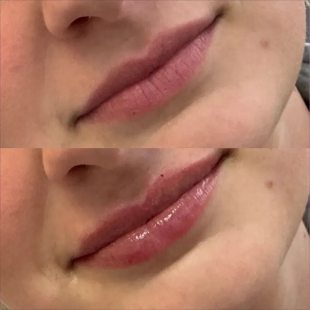 Before and after lip filler treatment: lips appear fuller and more defined after injection.