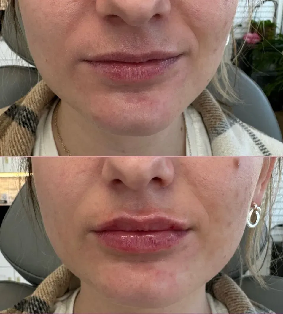 Side-by-side comparison of a person's lips. Top: unenhanced. Bottom: lip filler. Both show natural skin tone.
