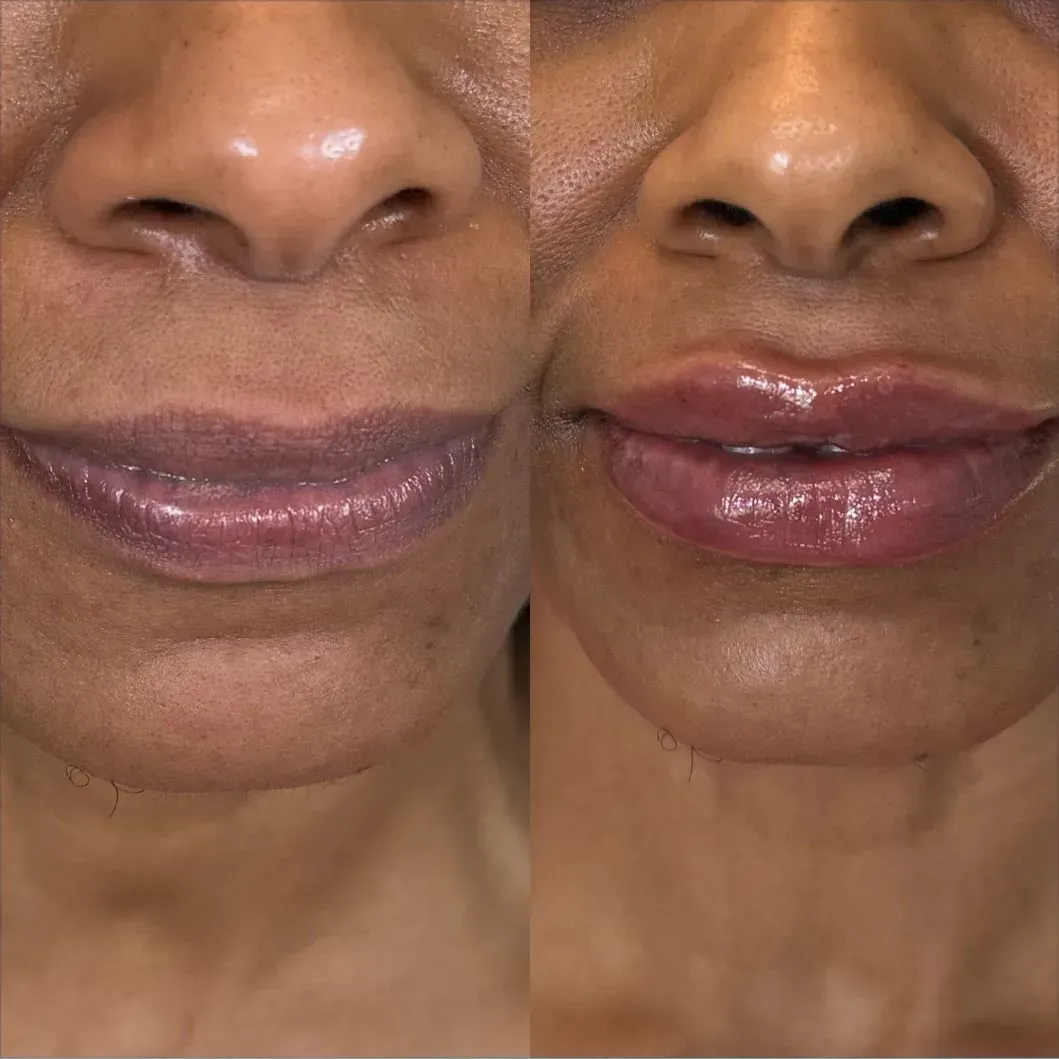 Before and after view of lips. The 