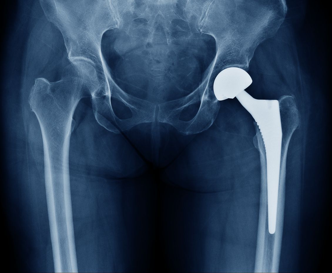 Class III medical device hip replacement implant