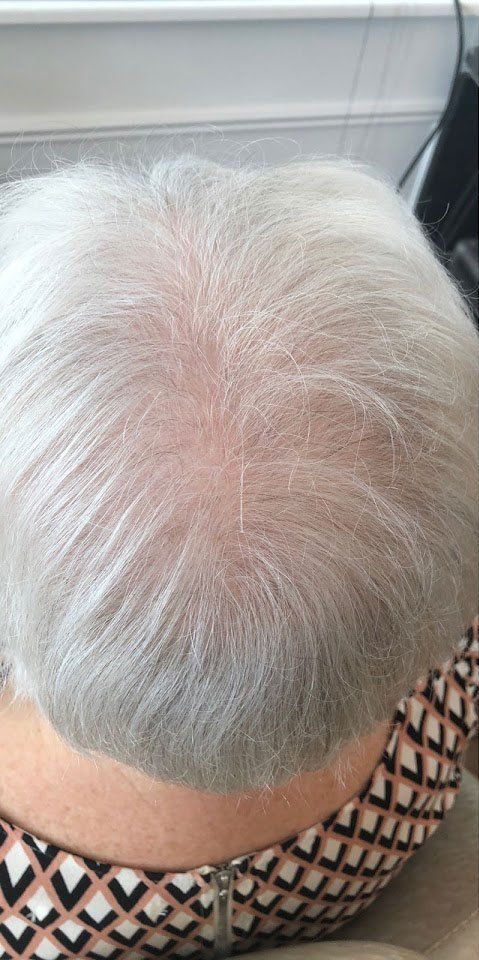 Hair loss solution by la bella vita in Belfast