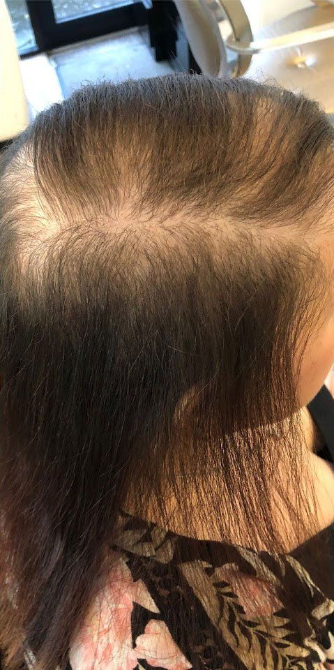 Hair loss solution by la bella vita in Belfast
