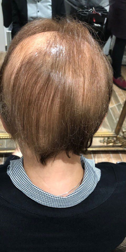 Hair loss solution by la bella vita in Belfast