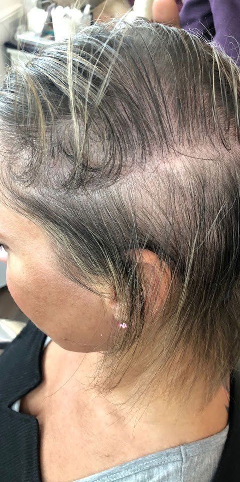 Hair loss solution by la bella vita in Belfast