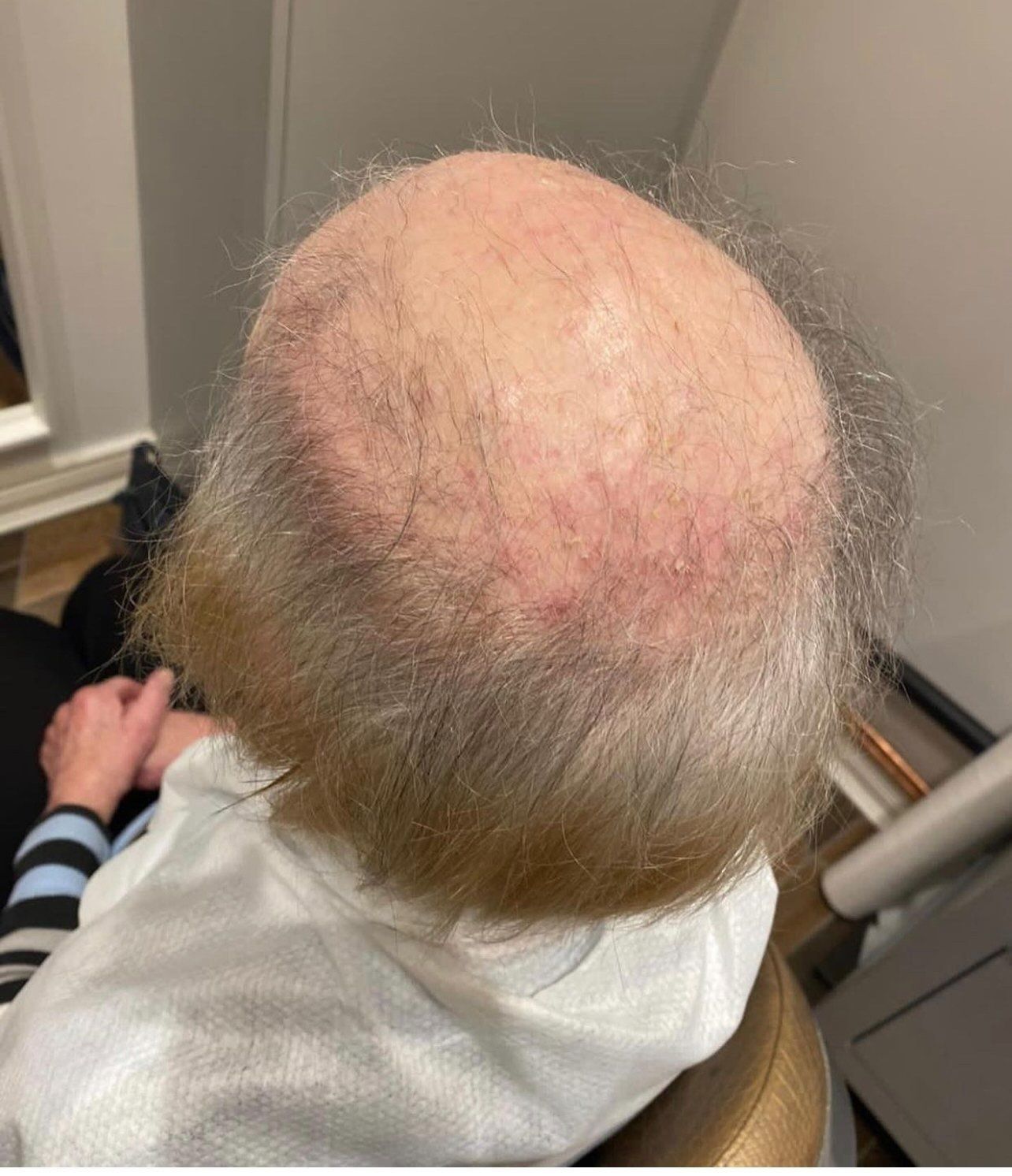 hair loss treatment by la bella vita in belfast