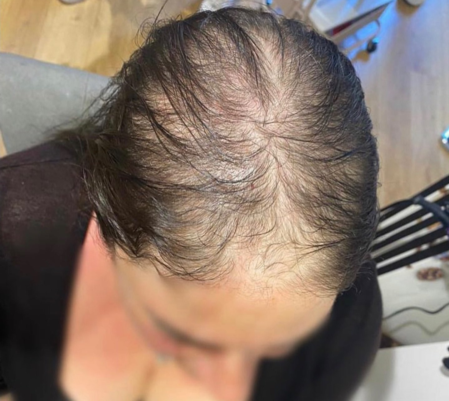 Hair loss solution by la bella vita in Belfast