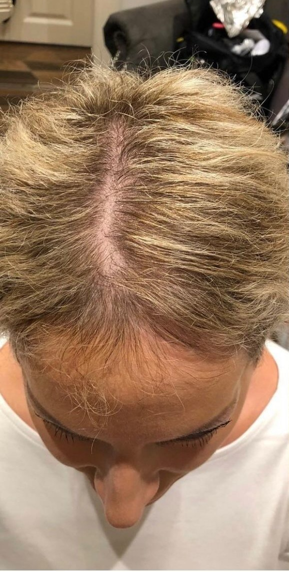 hair intergration system treatment by la bella vita in belfast