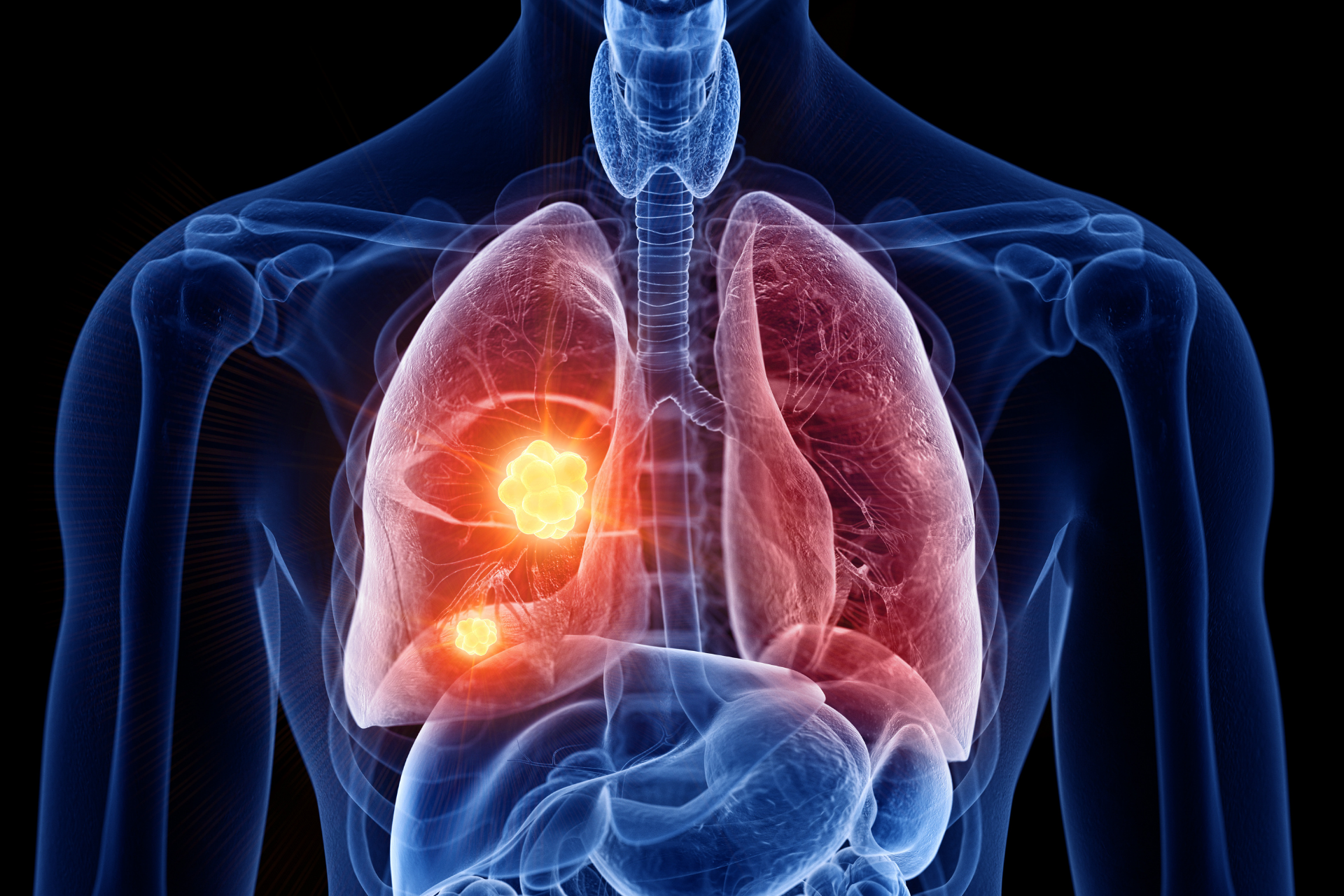 A computer generated image of a person 's lungs with a tumor in them.