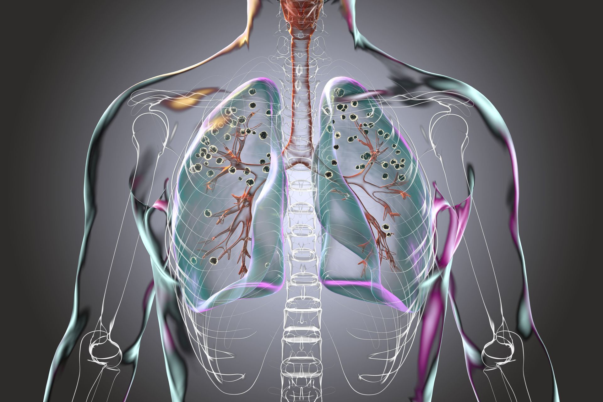 nódulo pulmonar