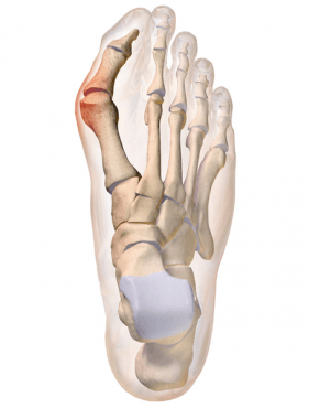 Hallux valgus