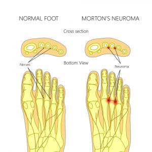 Mortons nevrom Mortons nevrom