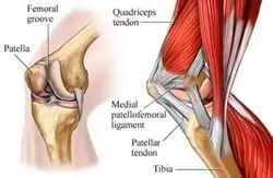 Patellofemoral-syndrom Patellofemoral-syndrom