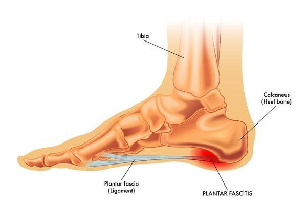 Plantar Fasciitt