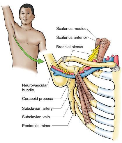 Thoracic outlet syndrom | diagnose og behandling