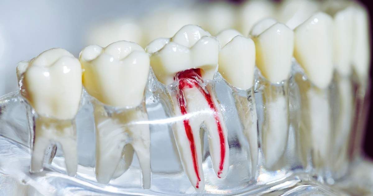 Model of teeth, one showing root canal with red-colored canals visible inside the tooth.